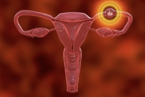 In Vitro Fertilization (IVF)