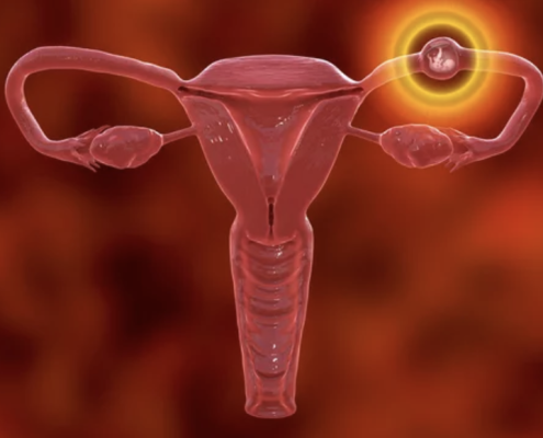 In Vitro Fertilization (IVF)