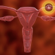 In Vitro Fertilization (IVF)