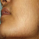 ارزیابی و درمان هیرسوتیسم