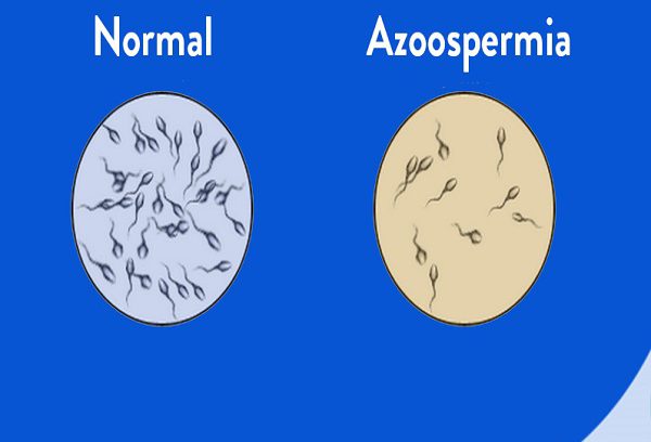 آزواسپرمی و ناباروری