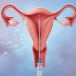 IUI چیست؟ آشنایی با روش درمان ناباروری داخل رحم